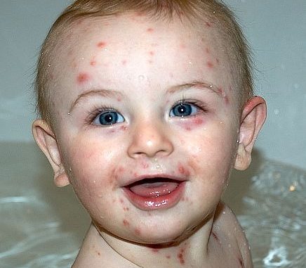 canada_chicken_pox_copy
