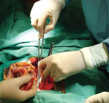 health_Heart-transplant