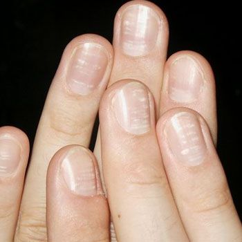 fashion_white_spotted_nails_care_tips