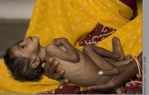 Malnutrition in India Malnutrition in India