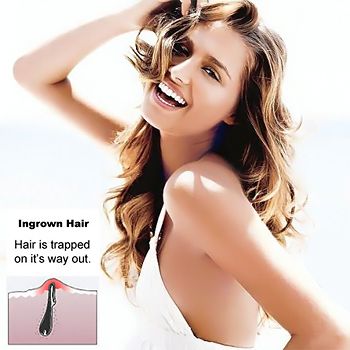 health_To_Prevent_Ingrown_Hairs_After_Epilation