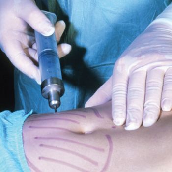 health_Lose_a_Fat_Cell_Get_a_Fat_Cell_Is_Liposuction_Worth_It