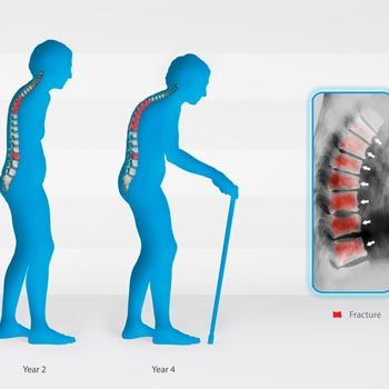 images_Lifestyle_Health_special_report_osteoporosis