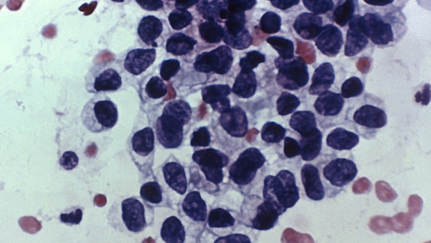 images_News_Canada_cancer