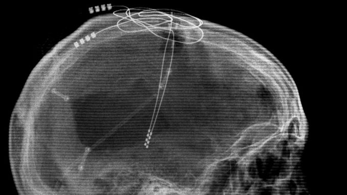 Scientist Find Hope For Severe Anorexia Nervosa Patients Using ‘Brain Pacemaker’