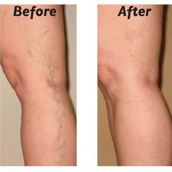 images_Lifestyle_DailyLife_varicose_veins