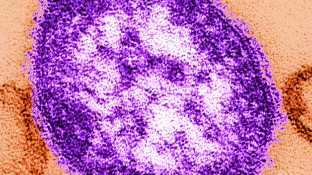 images_News_Canada_measles_copy_copy