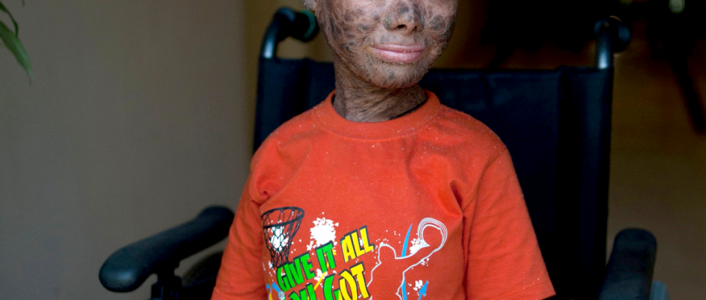 image-129 an indian teenager’s painful “human snake” skin condition has finally been cured