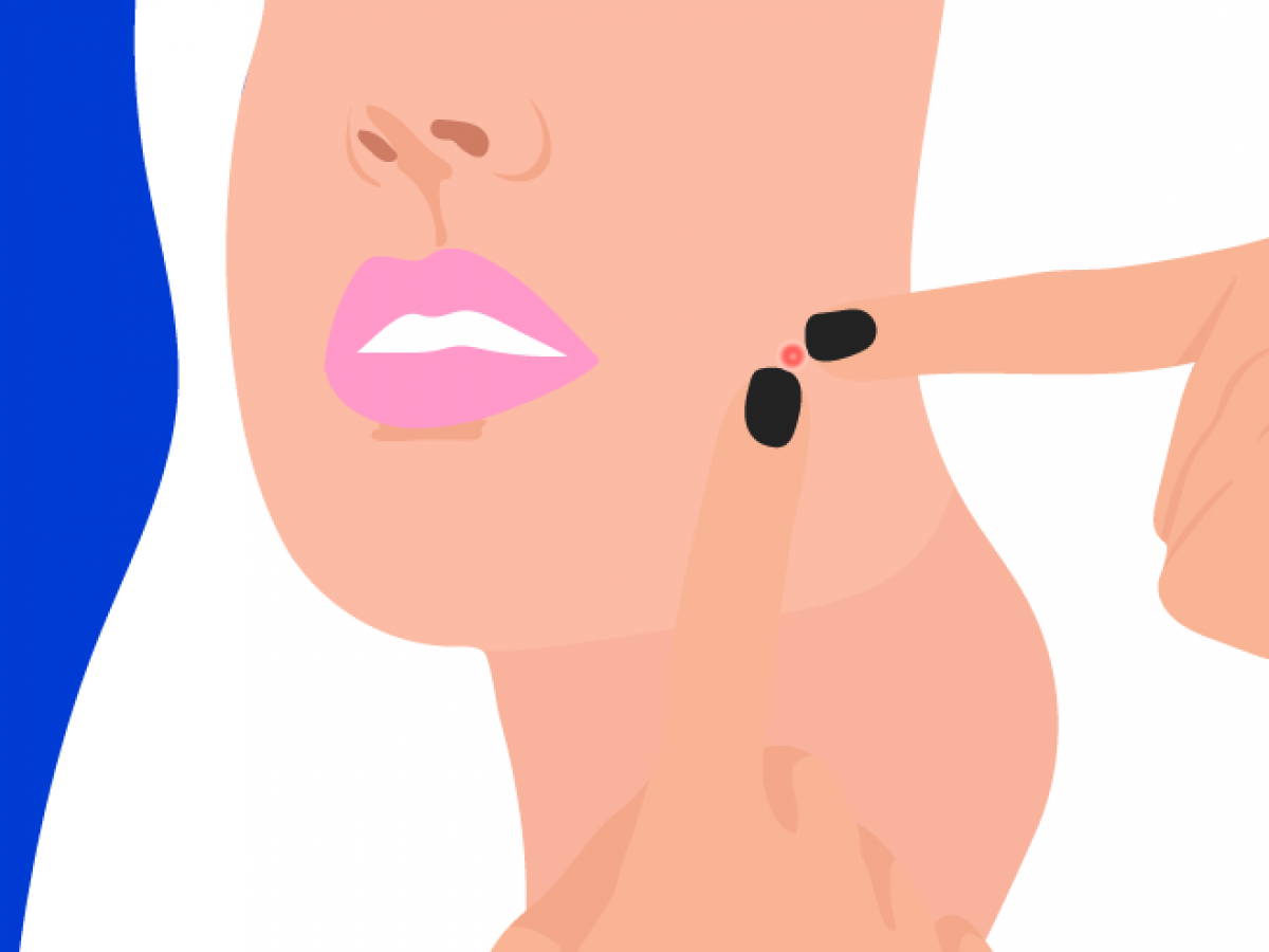 the mistakes you’re making with your acne scars & how to fix ‘em