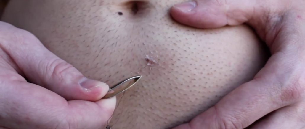 ingrown hair removal videos are the newest extraction craze
