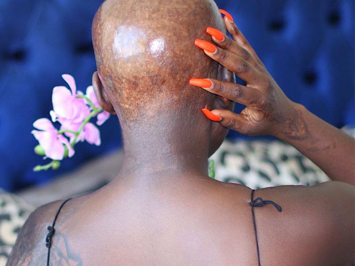 this burn survivor is showing off her scars to the world & youtube is rejoicing