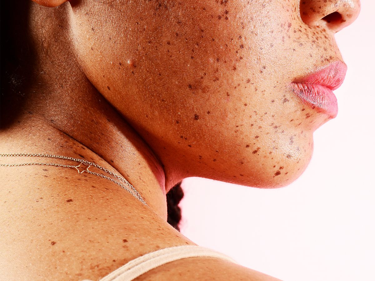 how to deal with skin tags, according to derms