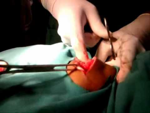 Dr. Pimple Popper Season 2, Episode 6 Features A Cyst Named Larry