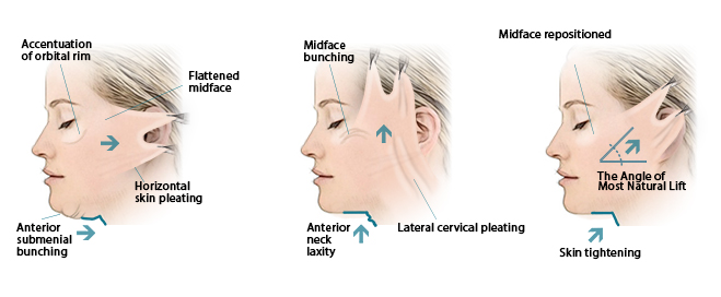 SMAS Facelift Vs. Deep Plane Facelift,