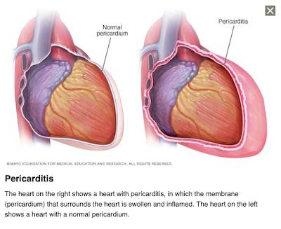 Myocarditis,Pericarditis and mRNA Vaccines