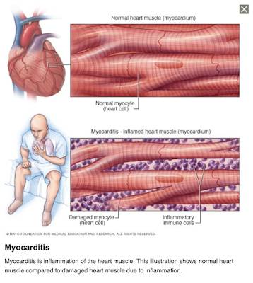 Myocarditis,Pericarditis and mRNA Vaccines