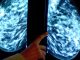 artificial intelligence, breast cancer, radiologists, mammograms, early detection